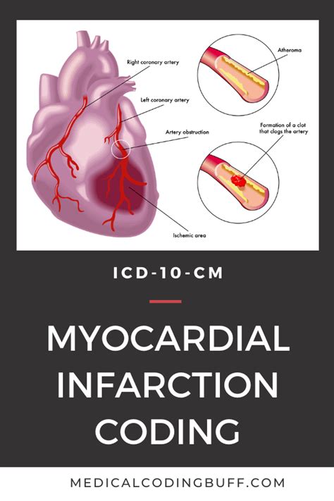 acute myocardial infarction icd 10 code